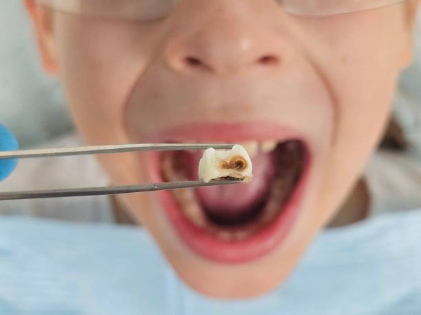 Best Broken or Chipped Tooth Repair in Quincy, MI